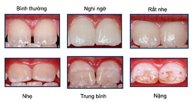 Răng nhiễm Fluor