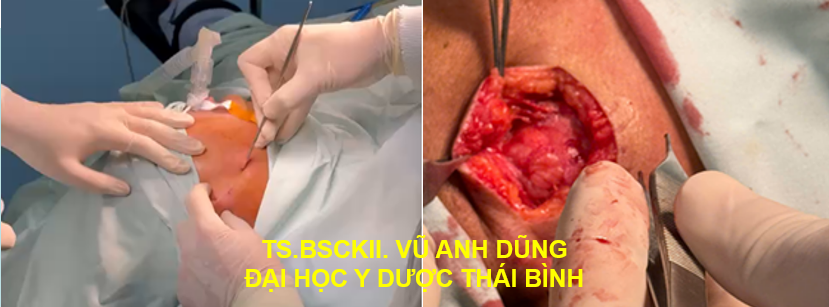 U HỖN HỢP TUYẾN NƯỚC BỌT