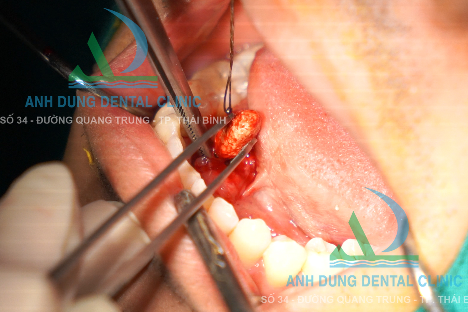 Phẫu Thuật Sỏi Ống Tuyến Nước Bọt Dưới Hàm
