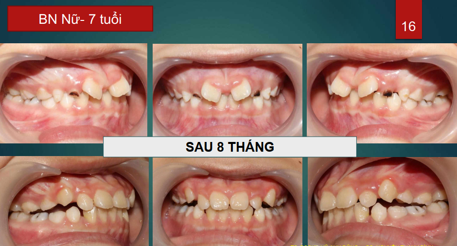 KHÓA HỌC CHUYÊN SÂU TWINBLOCK