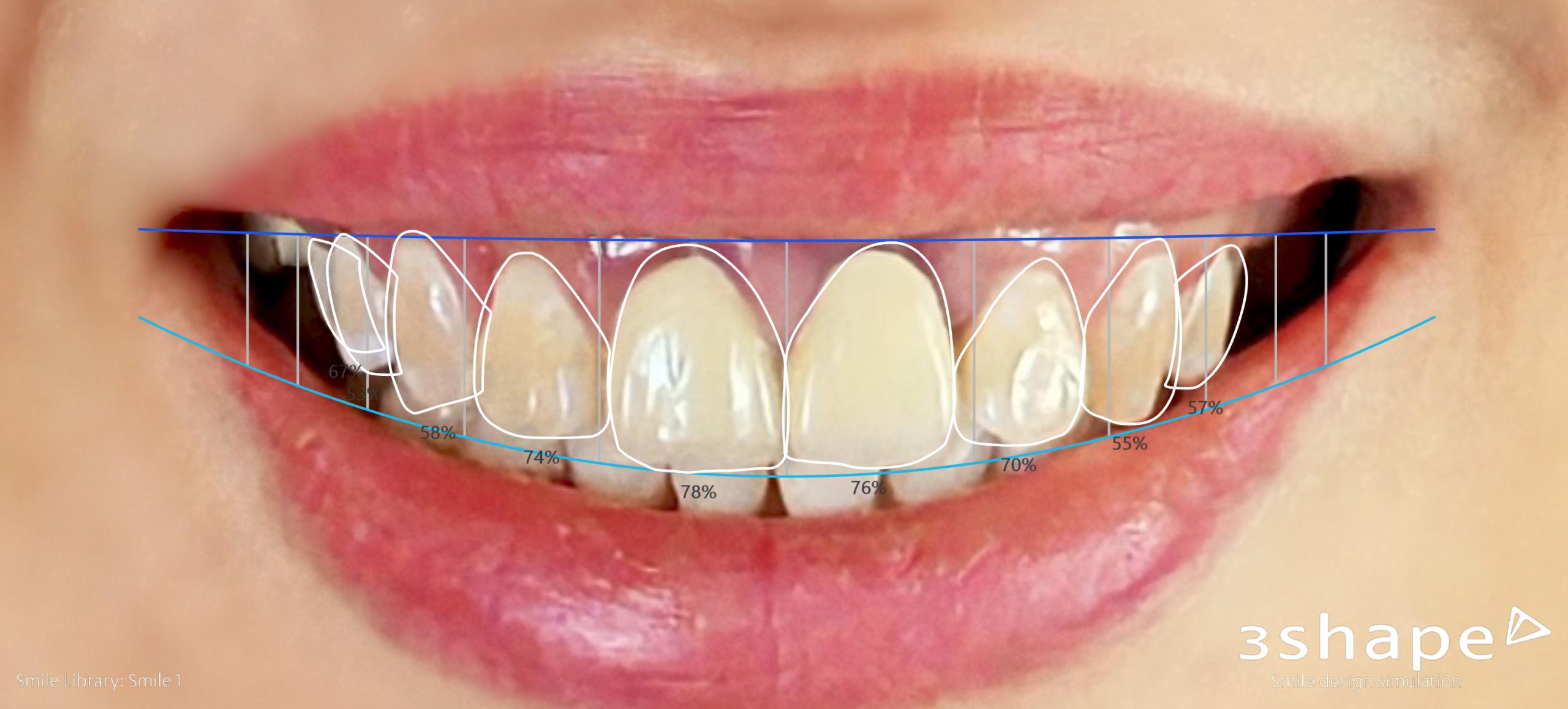 Dán Sứ Veneer