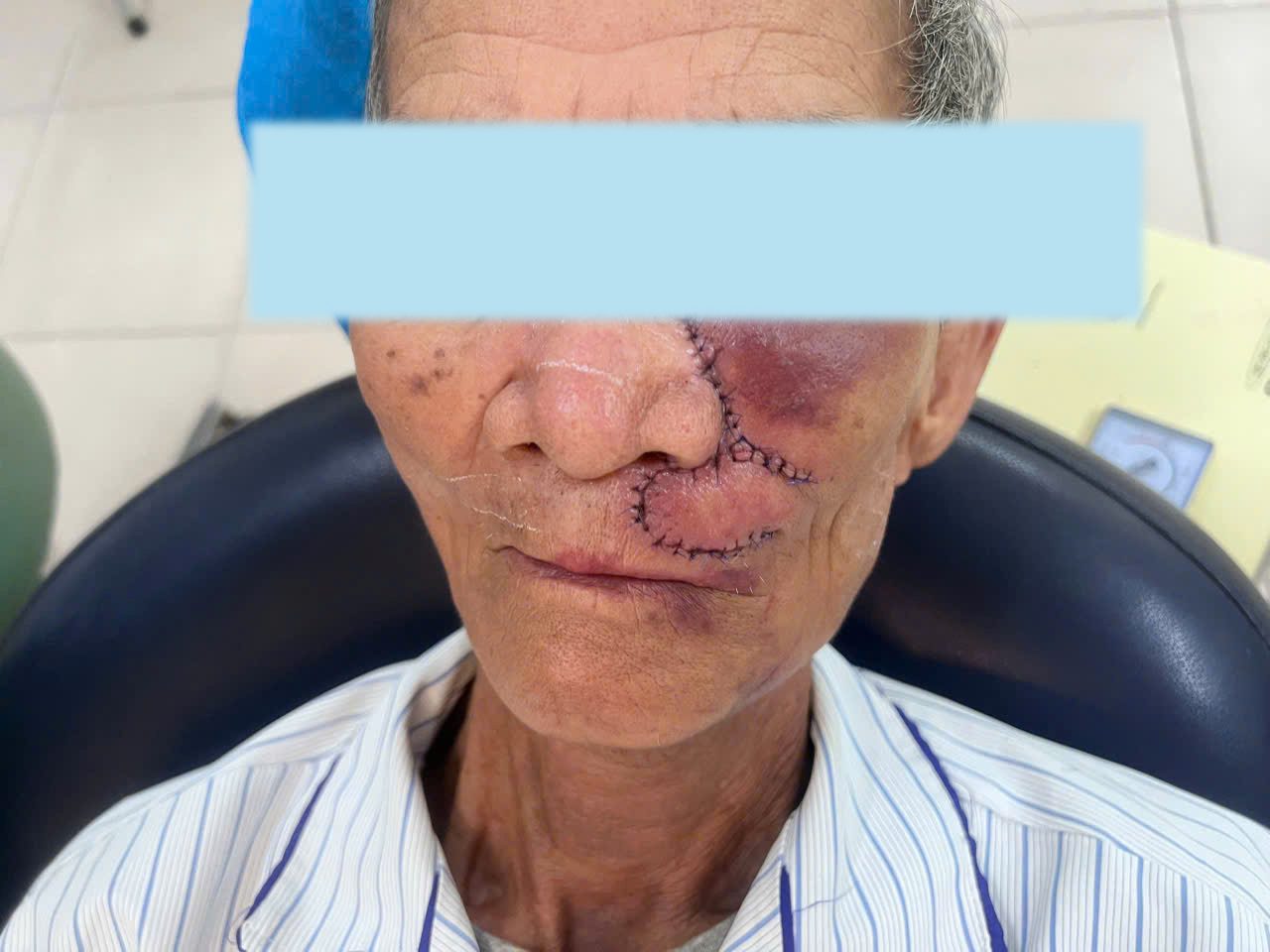 Ung Thư Biểu Mô Vùng Mặt